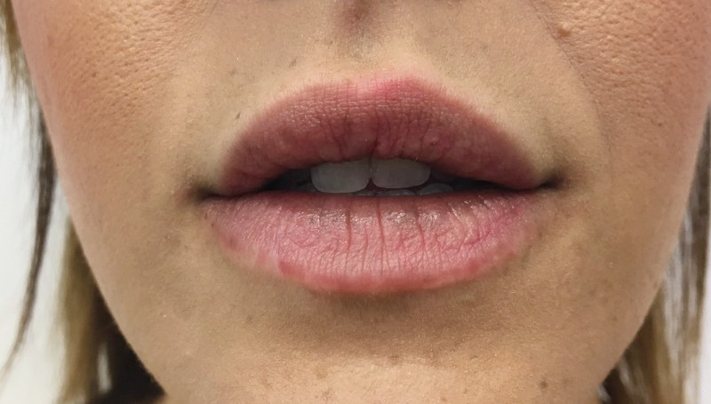 labios acido hialuronico