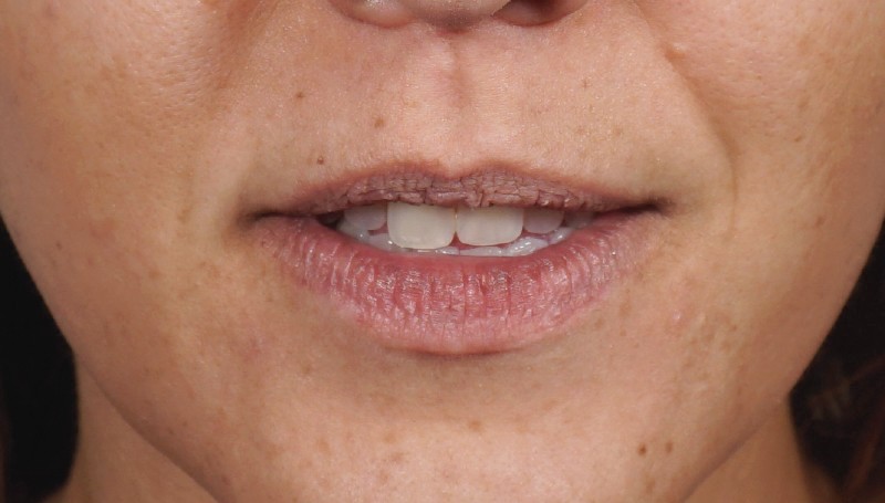 tratamiento labios en salamanca