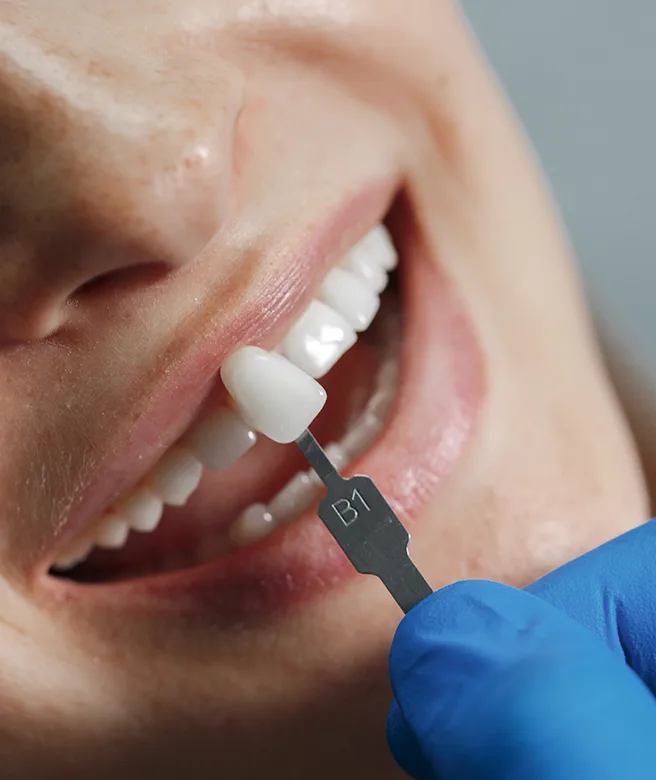 carillas-dentales-salamanca